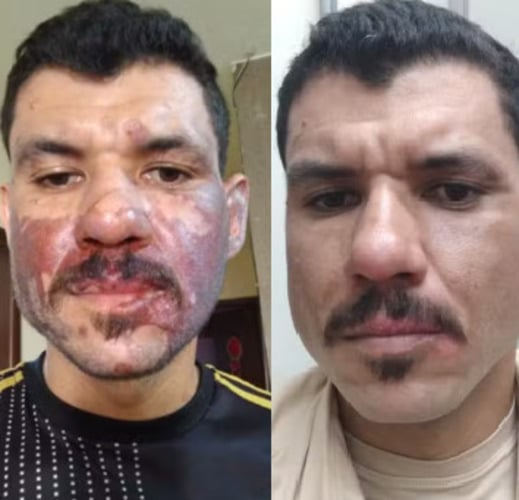 Um morador de Ponta Grossa, no Paraná, chamado Nataniel Freitas, revelou que foi vítima de uma 'explosão' de coxinha de galinha quando preparava o quitute na própria casa. Ele  foi atingido pelo óleo quente assim que tirou a coxinha da frigideira. Nataniel levou meses em tratamento contra as queimaduras e por sorte não ficou cego. Ele conseguiu ficar sem cicatrizes. -Reprodução arquivo pessoal 