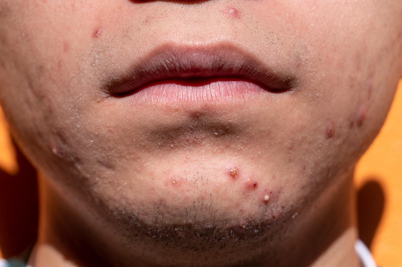 Acne atinge até 89% dos homens trans e impacta saúde mental